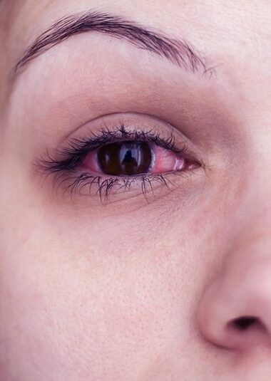 rode ogen na het slapen door allergie
