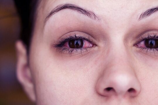 rode ogen na het slapen door allergie